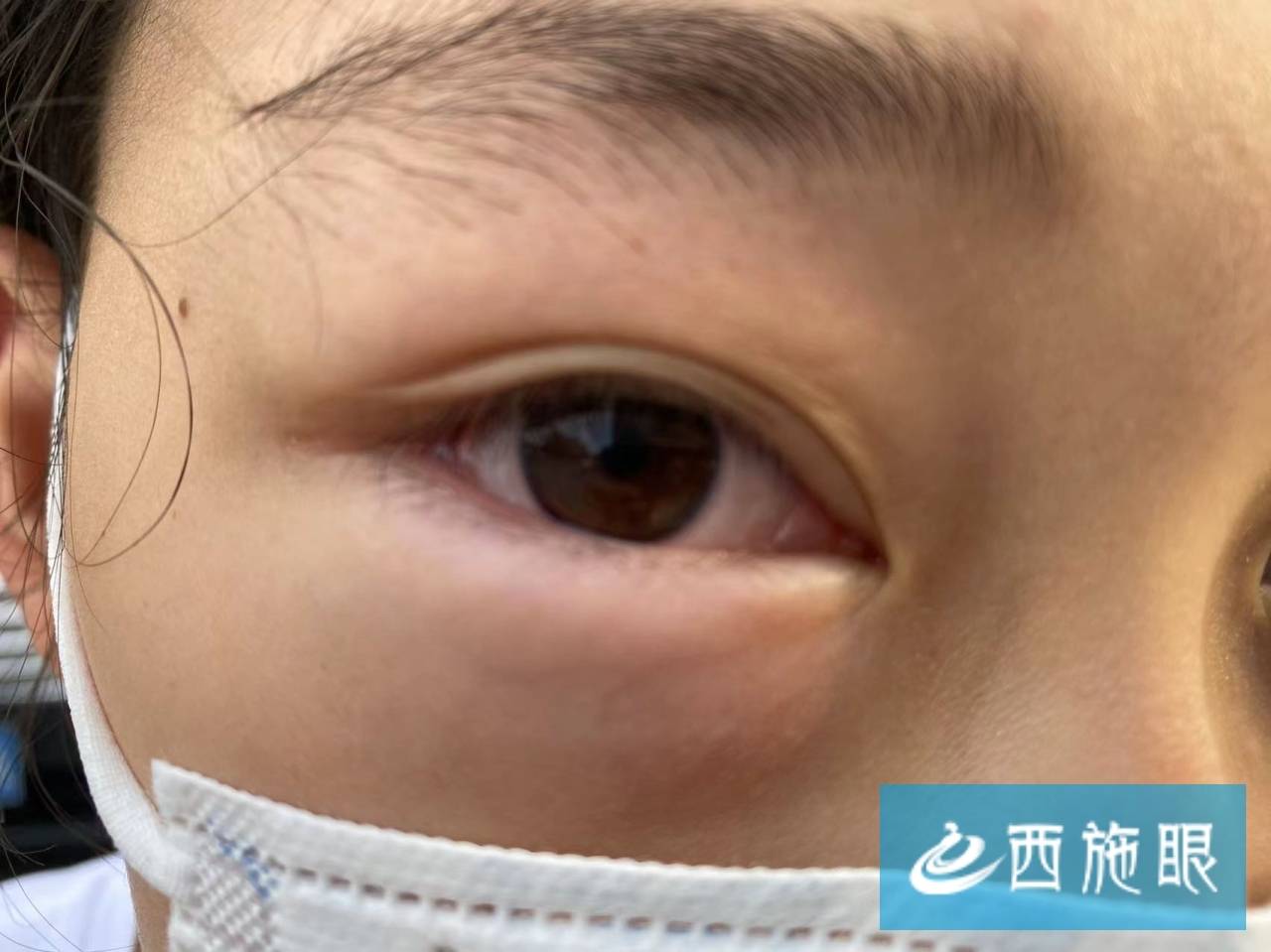 孩子眼睛虫子感染_狗狗频繁揉眼？异物和角膜溃疡_结膜吸吮线虫感染治疗
