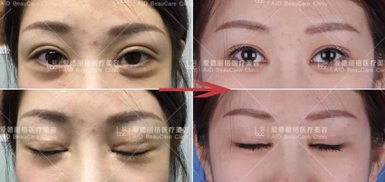 狗狗突然眼睑下垂？神经麻痹和重症肌无力_上睑下垂矫正术费用_上睑下垂修复案例