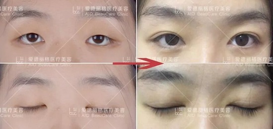 上睑下垂修复案例_上睑下垂矫正术费用_狗狗突然眼睑下垂？神经麻痹和重症肌无力