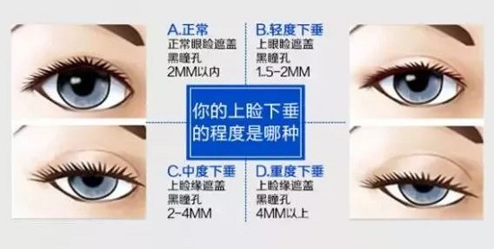 狗狗突然眼睑下垂？神经麻痹和重症肌无力_上睑下垂修复案例_上睑下垂矫正术费用