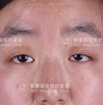 狗狗突然眼睑下垂？神经麻痹和重症肌无力_上睑下垂修复案例_上睑下垂矫正术费用