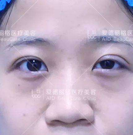 狗狗突然眼睑下垂？神经麻痹和重症肌无力_上睑下垂修复案例_上睑下垂矫正术费用