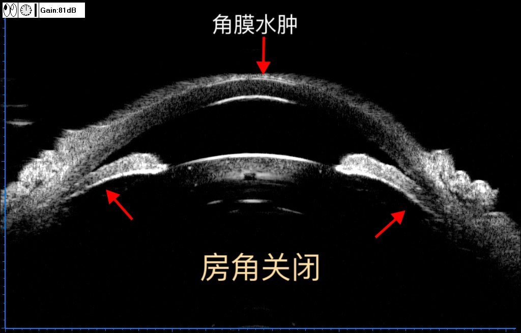 阳康后眼部不适症状_猫咪青光眼：眼压升高的紧急处理_新冠病毒感染眼底病变