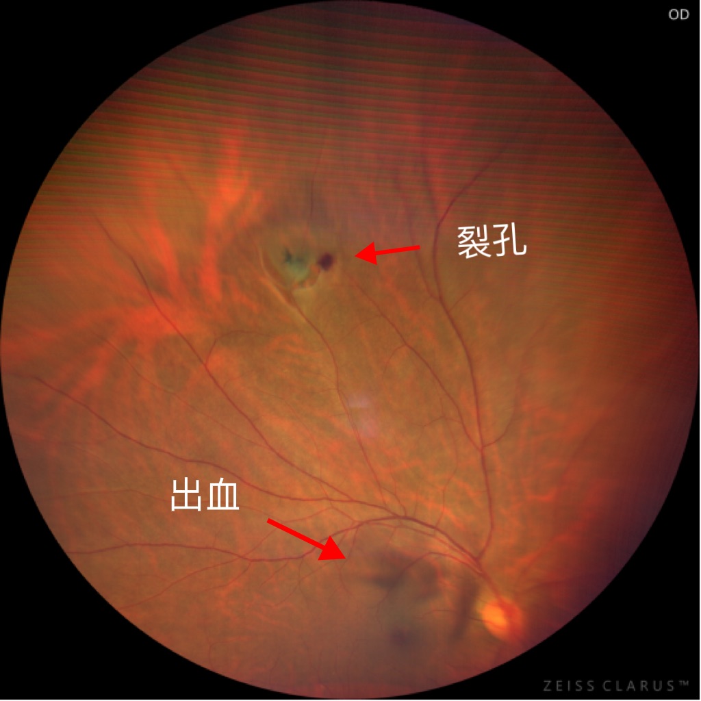 阳康后眼部不适症状_猫咪青光眼：眼压升高的紧急处理_新冠病毒感染眼底病变