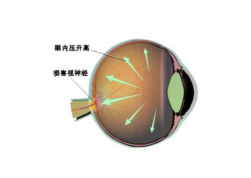 眼压高与青光眼关系_青光眼眼压检查方法_猫咪青光眼：眼压升高的紧急处理