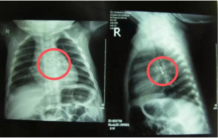 儿童呼吸道异物常见问题-派特超人-宠物