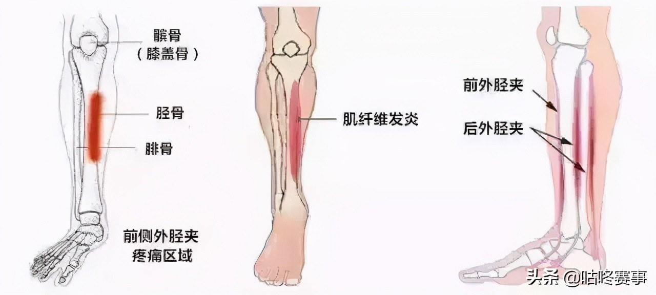 胫骨骨膜炎症状_跑步小腿疼痛原因_猫咪骨膜炎：创伤后骨膜反应