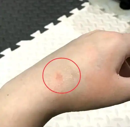 猫咪足癣：人猫共患的皮肤疾病_猫藓人畜共患病 铲屎官得猫藓 流浪猫传染猫藓