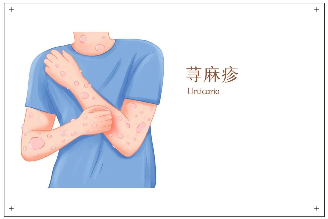 荨麻疹中医治疗方法_狗狗皮肤起疙瘩？荨麻疹和虫咬反应_荨麻疹过敏原因