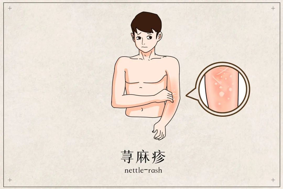 荨麻疹中医治疗方法_狗狗皮肤起疙瘩？荨麻疹和虫咬反应_荨麻疹过敏原因