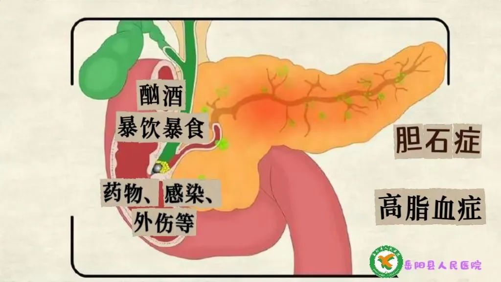 猫咪胰腺炎：剧痛疾病的预防方法_岳阳县人民医院胰腺炎治疗_急性胰腺炎症状