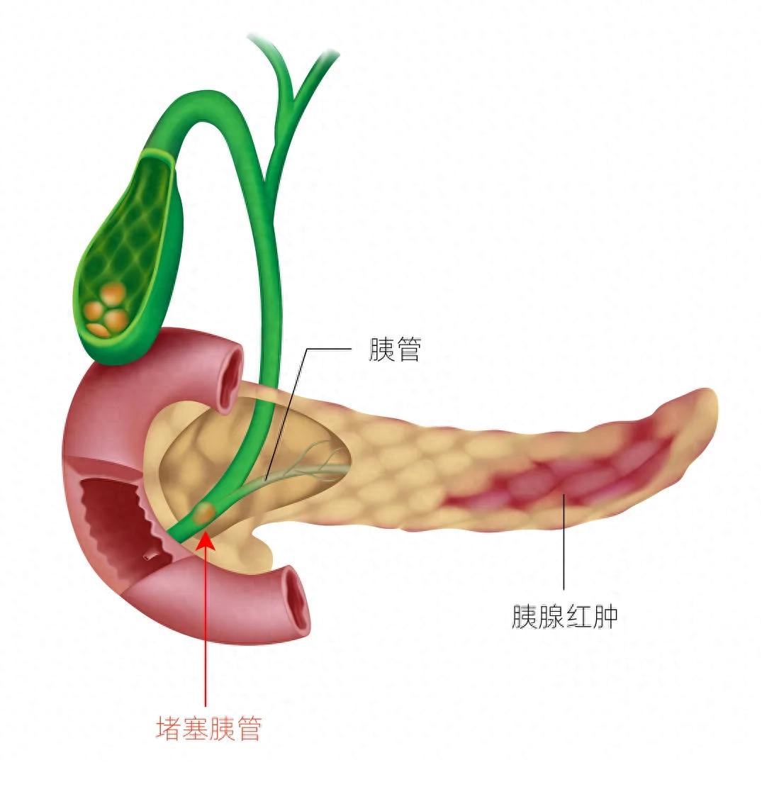 血脂高别轻视,诱发急性胰腺炎很凶险-派特超人-宠物